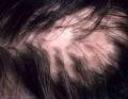 cicatricial-alopecia.jpg