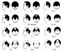 male-pattern-hair-loss.gif