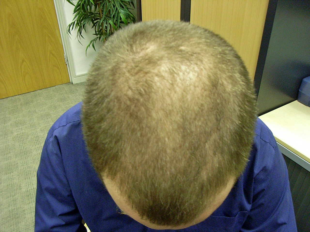 The Hair Centre Hair Loss Blog