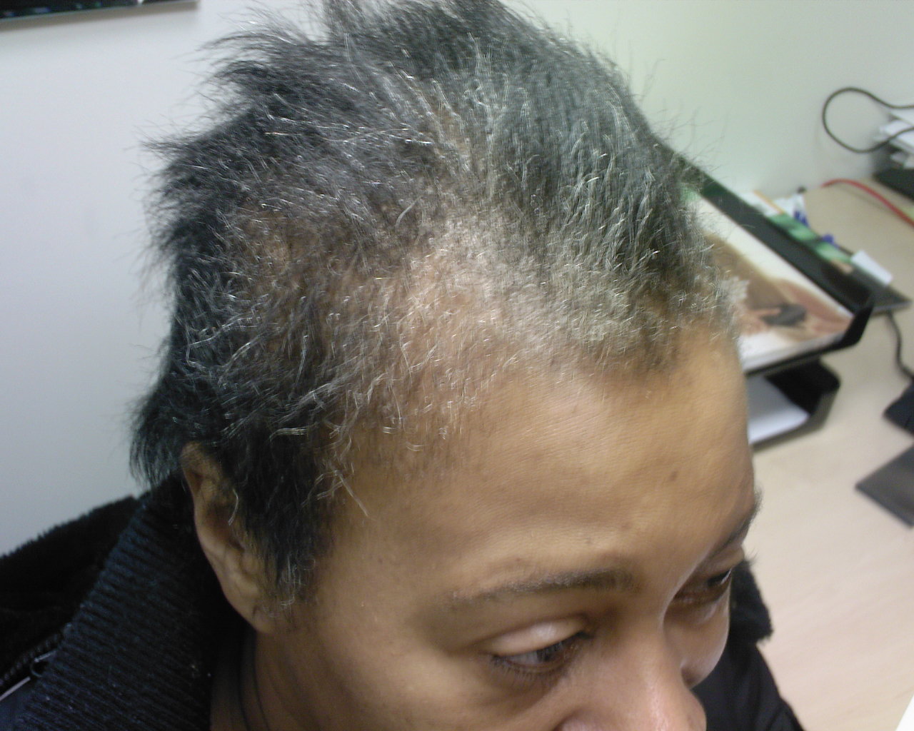 The Hair Loss Centre | Female Hair Loss (Black Hair) In Just 12 Months Of  Treatment