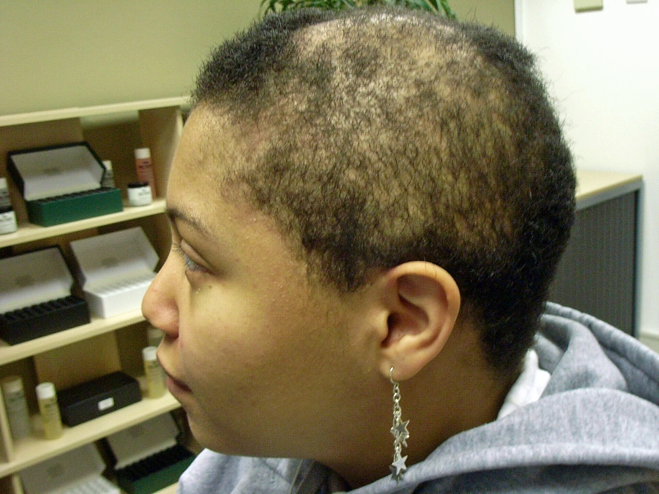 The Hair Loss Centre | Female Hair Loss: BLACK AFRO-CARIBBEAN HAIR (Results)