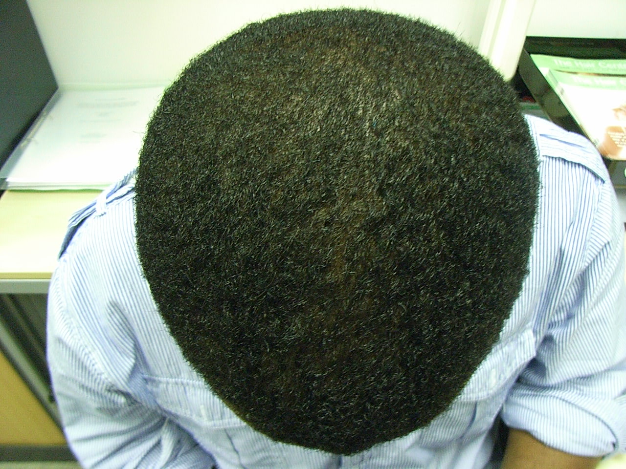 The Hair Loss Centre | MALE HAIR LOSS: (BLACK AFRO CARRIBEAN) RESULTS