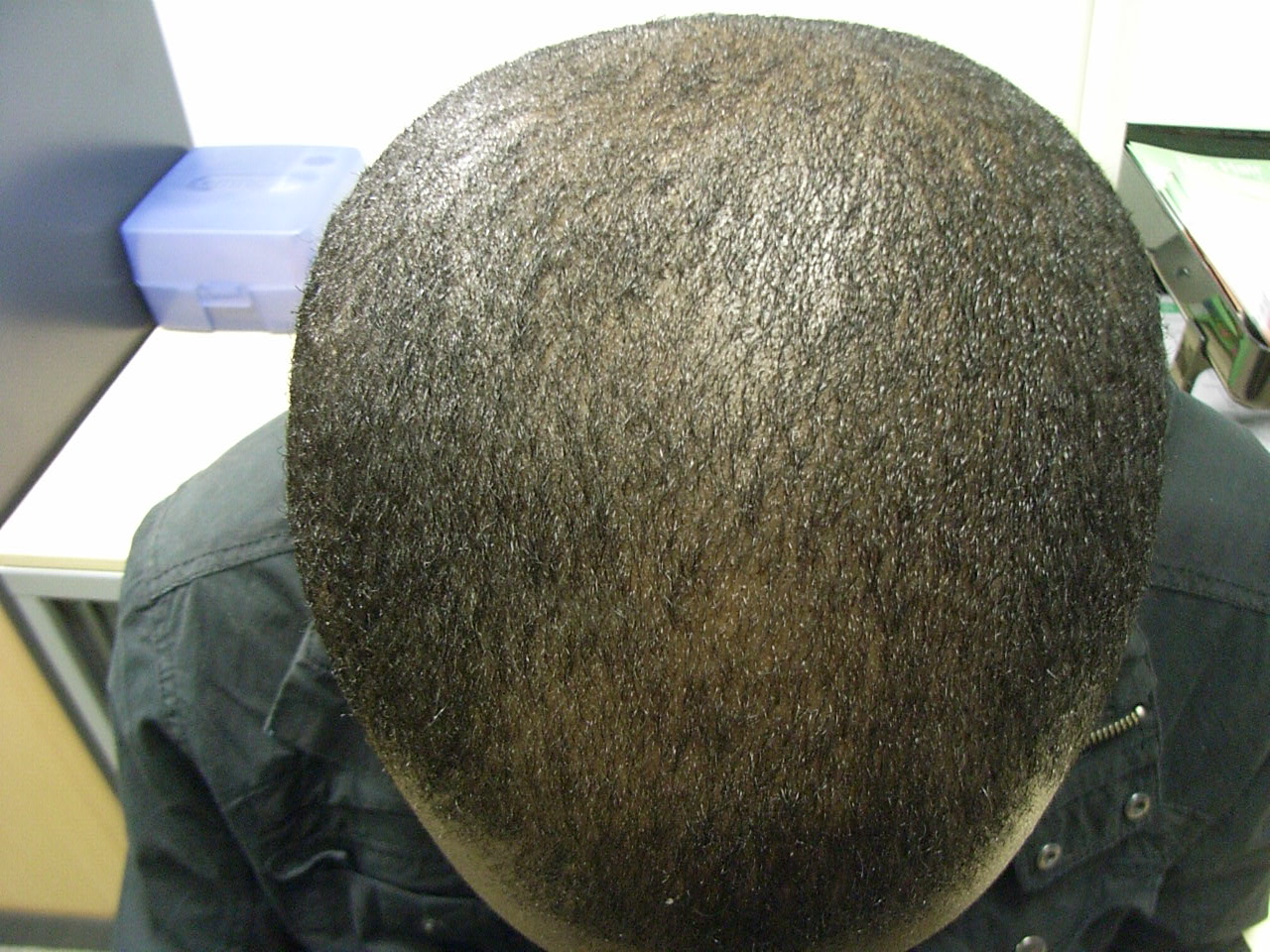 The Hair Centre MALE HAIR LOSS BLACK AFRO CARRIBEAN RESULTS