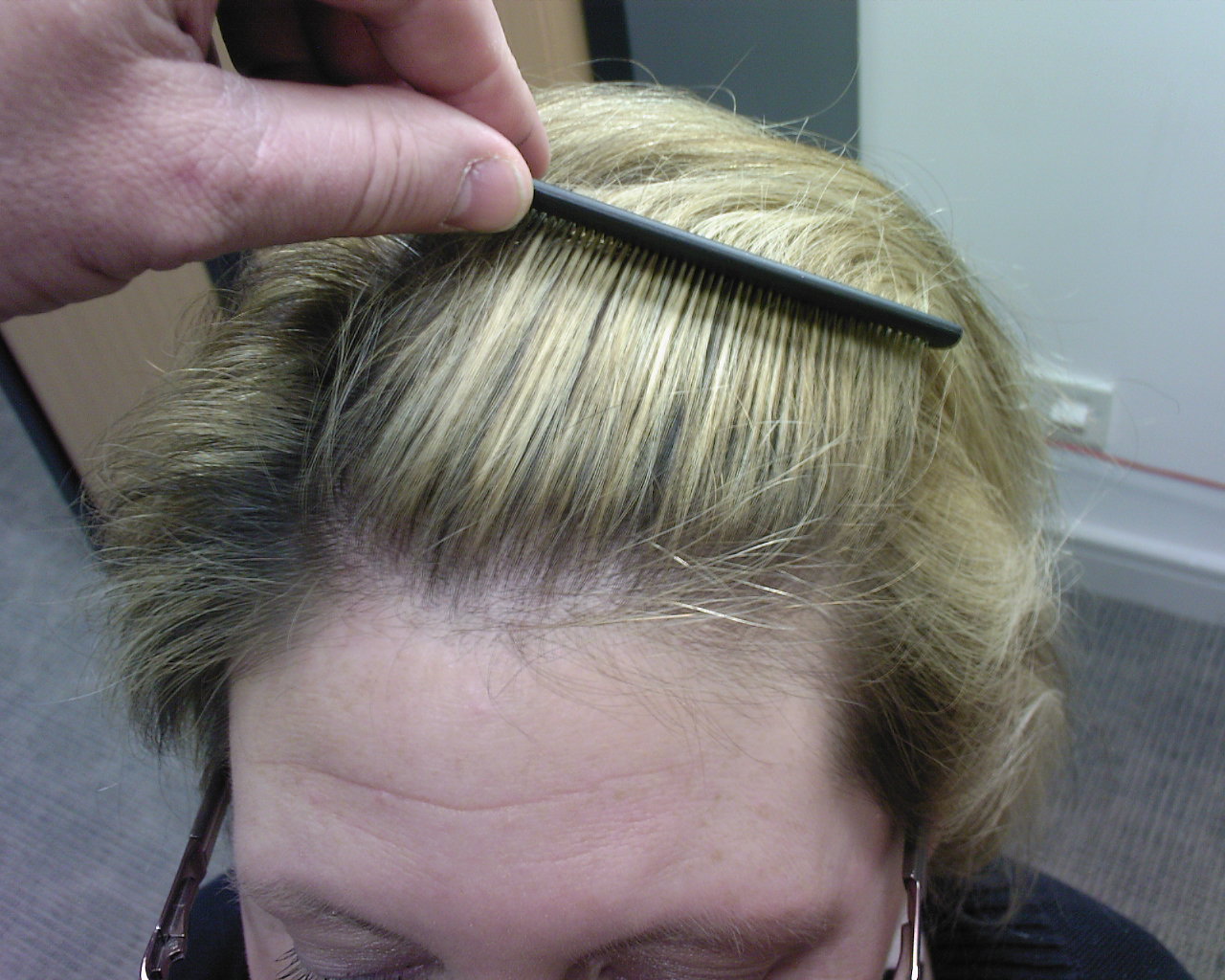 The Hair Loss Centre | FEMALE HAIR LOSS