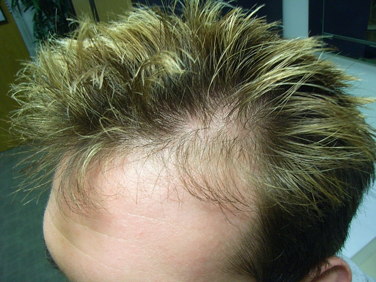 The Hair Loss Centre | MALE HAIR LOSS: Is There A Solution To MPB (Results  In 3 Months)