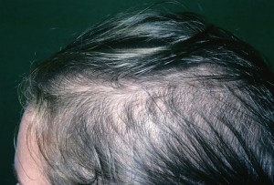 phototake_rm_photo_of_female_hair_loss