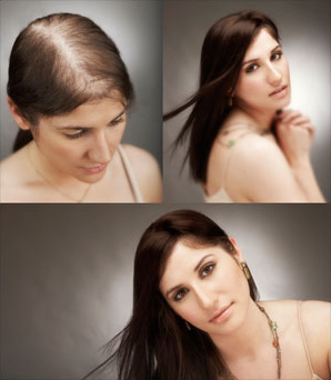 hair-loss-in-women-2