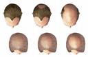 androgenetic-alopecia