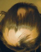 hair-loss-research-alopecia-areata
