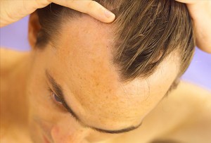phototake_rm_photo_of_male_hair_loss