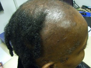 The Hair Loss Centre | Black female hair loss treated