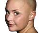 alopecia universalis.