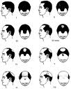 Male Hair Loss Scale