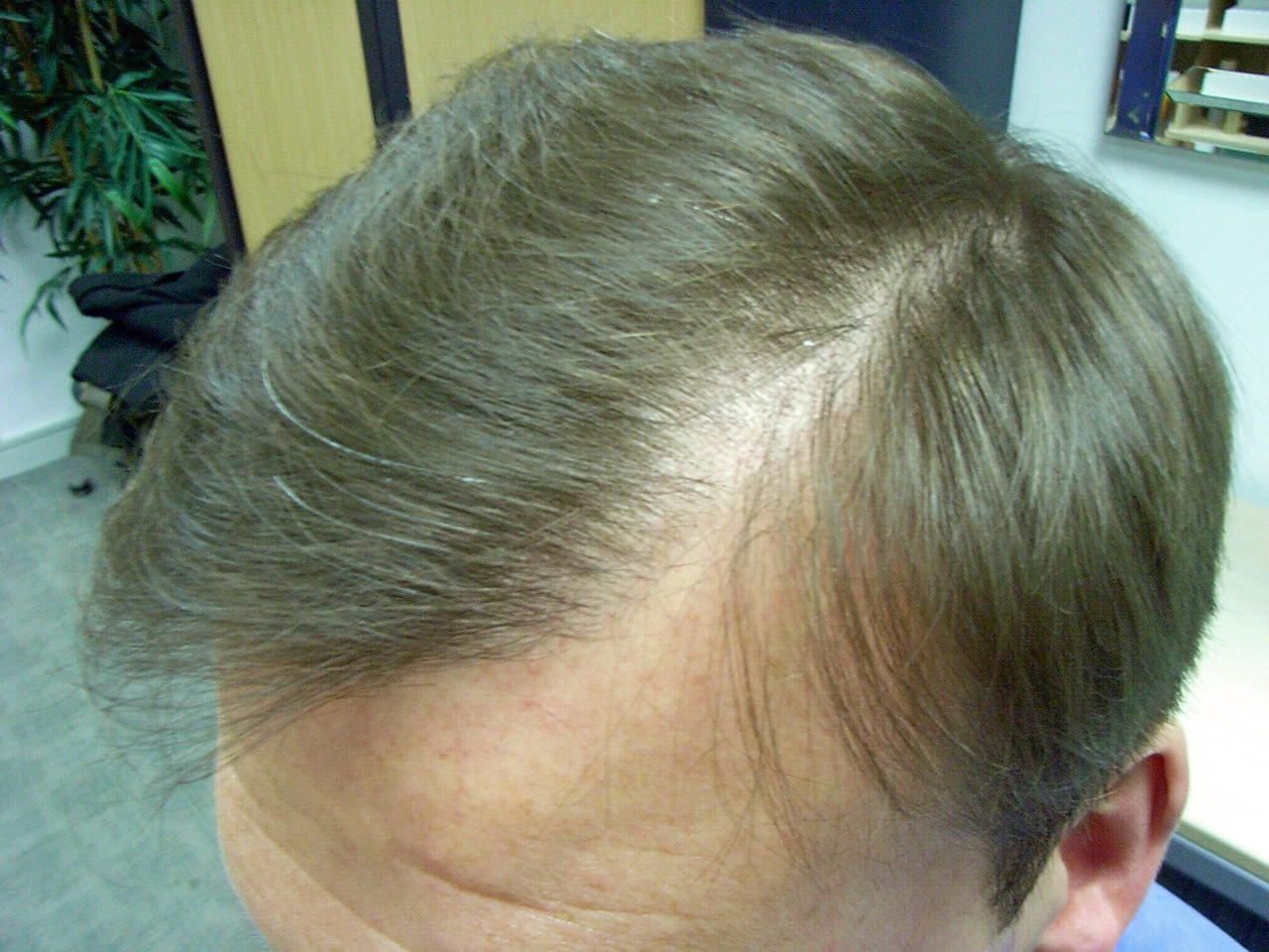 Low Ferritin Hair Loss Uphairstyle.